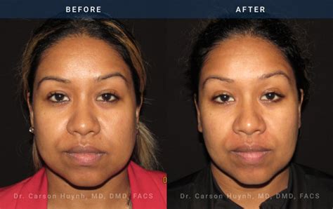 Buccal Fat Reduction Atlanta, GA | Radiance Surgery and Aesthetic Medicine