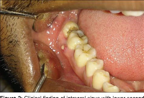 Figure 1 from Pattern of mandibular third molar impaction and its ...