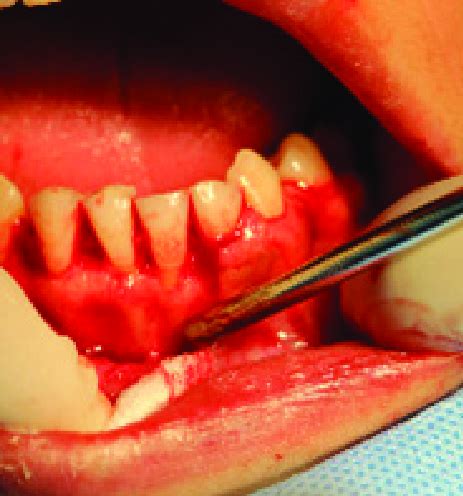 Incisional biopsy procedure. | Download Scientific Diagram