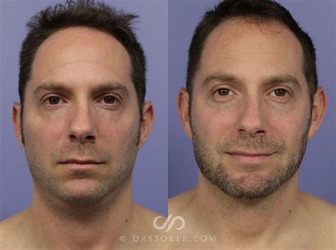 Juvederm Cheeks Before And After Photos