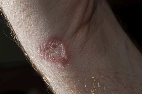 Ringworm Fungal Infection: Causes, Symptoms and Treatment - Treating Fungus