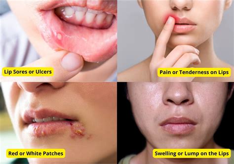 Lip Cancer: 5 Symptoms, Causes & Treatment