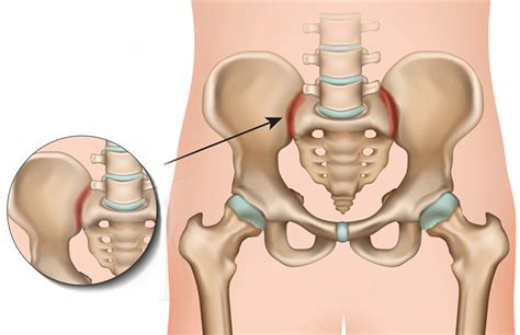 Treatment for Sacroiliac Joint Dysfunction