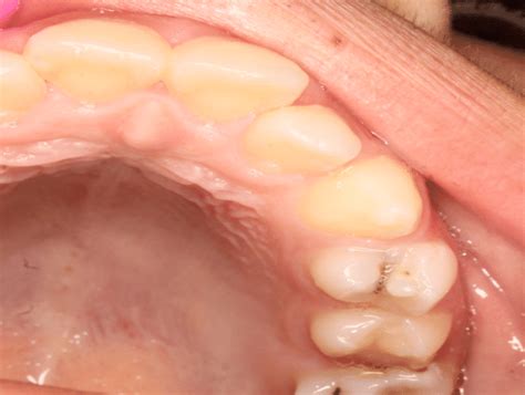 Shovel-shaped incisors and dens evaginatus. | Download Scientific Diagram