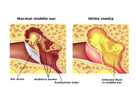 Middle Ear Infection - Cure For Otitis Media