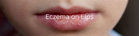 Eczema On Lips