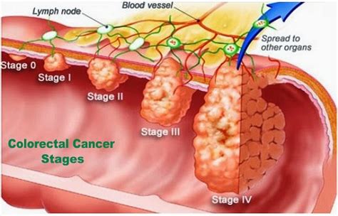 Colon Cancer And Colon Cancer Symptoms Colon Cancer Symptoms - Riset