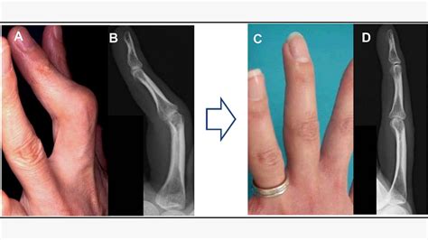 Before and After Rheumatoid Arthritis Surgery on Hands, Feet