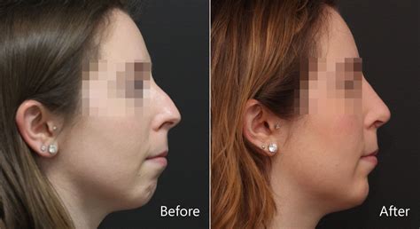 Chin Implants Photos | Princeton, NJ | Patient 8955