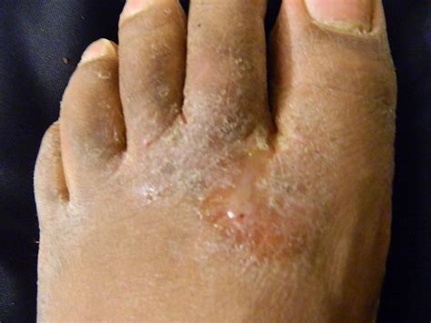 Athletes Foot | Causes, Signs & Symptoms | Treatment