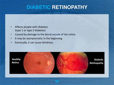 The Most Common Retinal Diseases