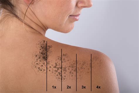 Laser Tattoo Removal - Eluma - Laser & Aesthetics