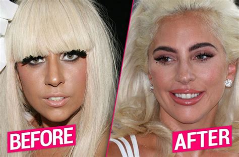 Lady Gaga's Plastic Surgery Makeover Exposed By Top Docs