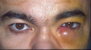 Itchy Tear Duct: In One Eye, Swollen, Causes, Treatment for Red Inflamed Tear Ducts — Brighter Press