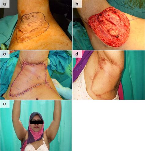 Intraoperative image of severe left axillary hidradenitis suppurativa... | Download Scientific ...