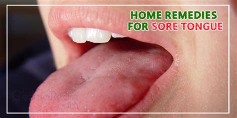 Home Remedies for Treating Sore Tongue - Getinfopedia.com