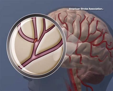 Obsessive Compulsive Disorder Linked to Increased Stroke Risk