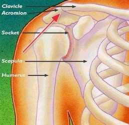 Shoulder Separation - OrthoInfo - AAOS