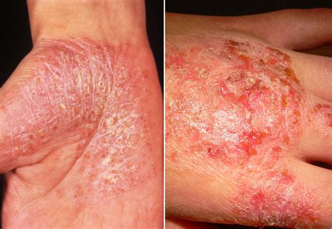Plaque Psoriasis Vs Eczema