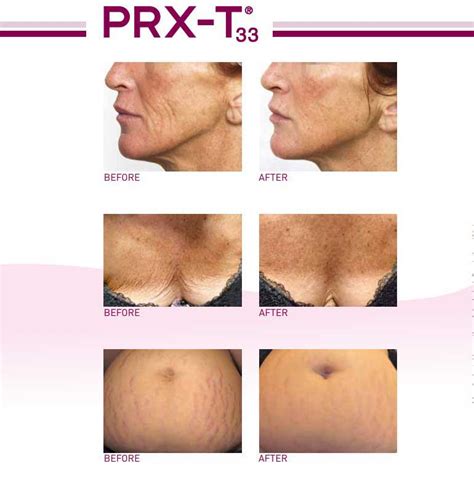 PRX-T33 Treatment - loveSkin Aesthetics, Bury