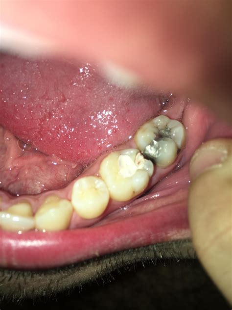 Root canal done today. Part of temporary filling came out with bleeding : Dentistry