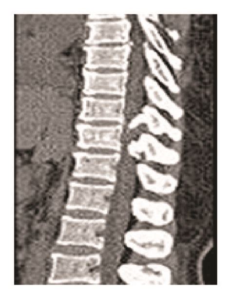 CT thoracic spine shows T10-T11 vertebral body and disc regeneration. | Download Scientific Diagram