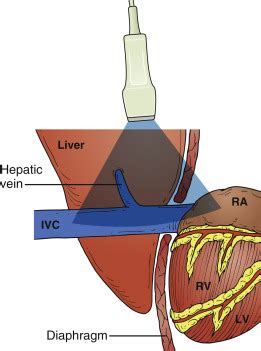 Inferior Vena Cava | Radiology Key