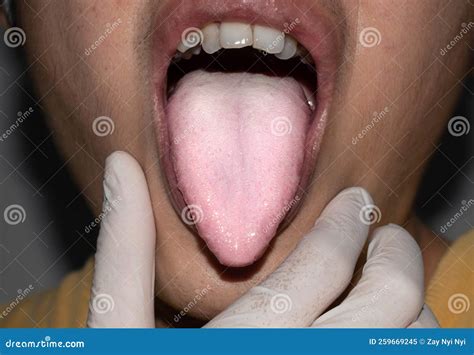 Coated Tongue or White Tongue. Loss of Taste Called Ageusia Stock Image ...