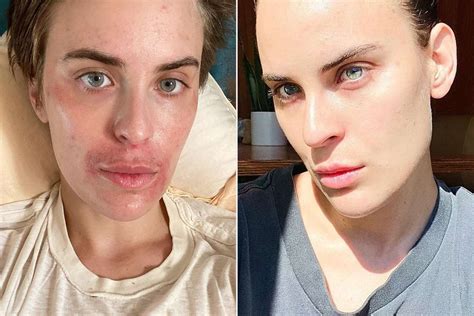 Tallulah Willis Gets Candid About Her Skin Struggles | PEOPLE.com