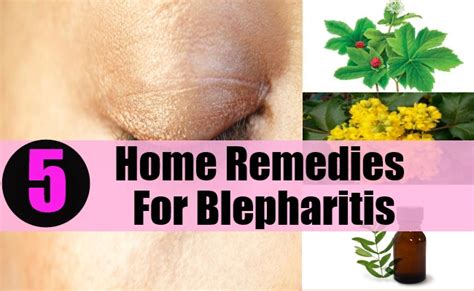 5 Home Remedies For Blepharitis – Natural Home Remedies & Supplements