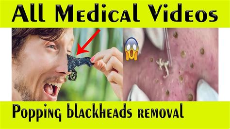 Popping blackheads | Removal Popping Blackheads treatment extraction | All Medical Videos - YouTube