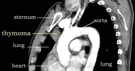 Prognosis of myasthenia gravis |Genetic Engineering Info