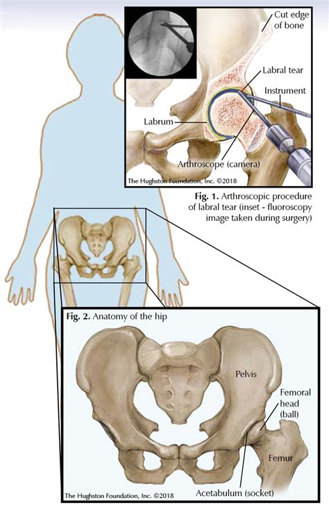 Hip Arthroscopy - Georgia