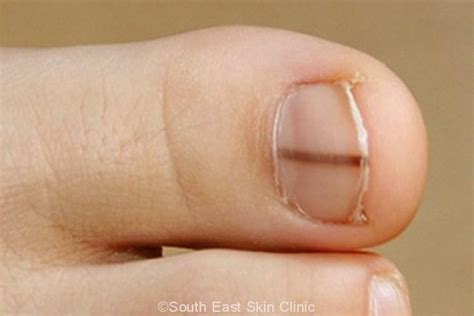 Nail Melanoma - South East Skin Clinic