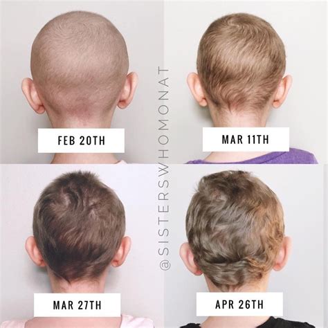 15 Hair Regrowth After Chemo Pictures Ideas - Endaily