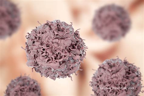 Immunotherapy Combinations Add Treatment Options in Advanced NSCLC