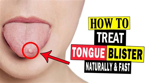 How to Get Rid of Tongue Blisters Naturally at Home || Home Remedies for Tongue Blisters - YouTube