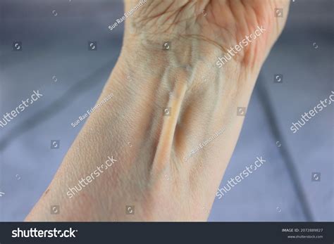 276 Palmaris longus Images, Stock Photos & Vectors | Shutterstock