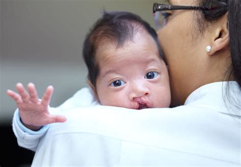 Penyebab Bibir Sumbing Pada Bayi Dari Lahir, Cegah Dari Sekarang! | HonestDocs