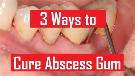 Dental abscess