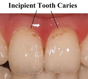 What is incipient caries? | News | Dentagama