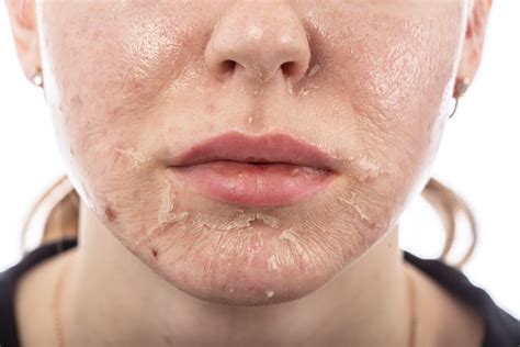 Everything You Need to Know About Chemical Peels – SLMD Skincare by Sandra Lee, M.D. - Dr ...