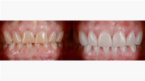 How are Dental Veneers Applied? - favourite dentistry