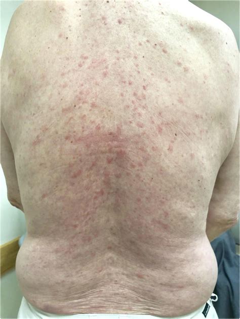 M152 SCHNITZLER’S SYNDROME: A RARE MIMICKER OF CHRONIC URTICARIA ...