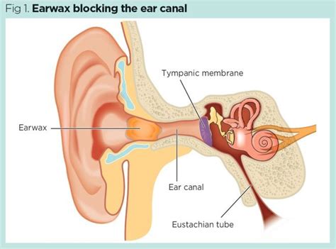 Earwax impaction: why it needs to be treated in primary care | Nursing ...