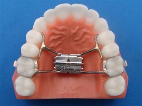 Everything You Need to Know About Palatal Expanders in Orthodontics - Family Braces