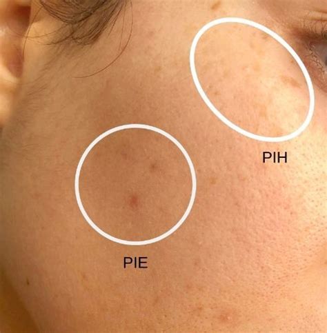 Acne Scarring, PIH & PIE: Differences, Causes & Treatments — Babe + Beauty #AcneScarsPit… | Acne ...