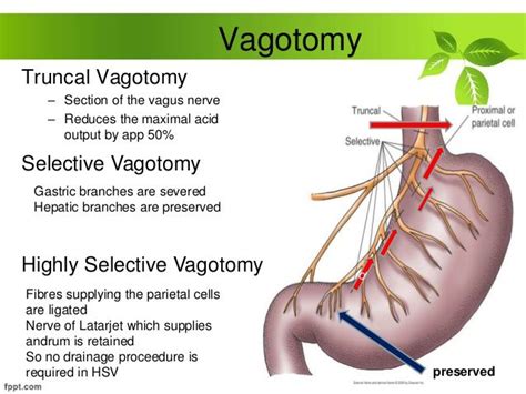 Výsledok vyhľadávania obrázkov pre dopyt vagotomy | Vagus nerve, Nclex, Severe