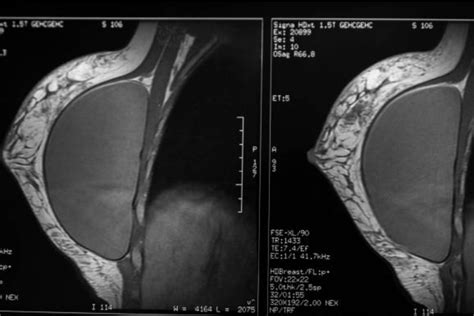 Breast Implants and Lymphoma - Breast Surgery & Breast Oncology