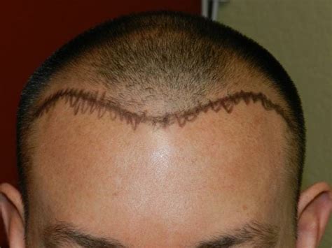 Hair Transplant Alternatives: Is FUT the Right Choice for You? | by ...